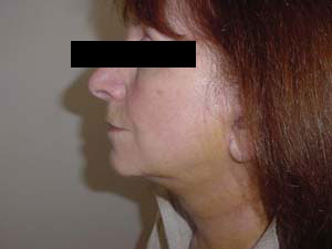 Facelift Results Santa Monica