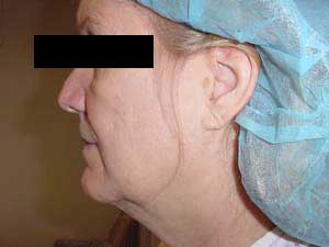 Face & Necklift Results Santa Monica