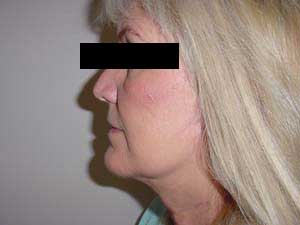 Face & Necklift Results Santa Monica