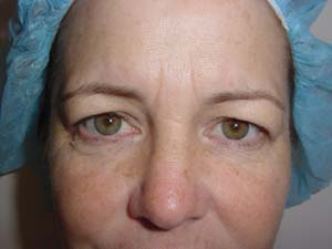 Blepharoplasty Result Santa Monica