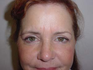 Blepharoplasty Result Santa Monica