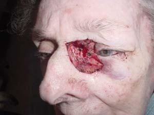 Reconstructive Surgery Results Santa Monica