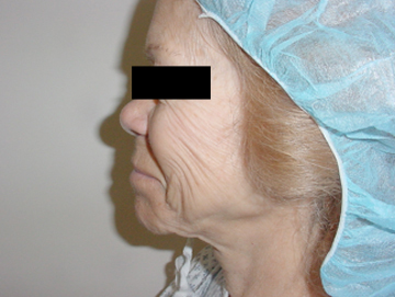 Facelift Santa Monica