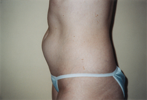 Pre-Op Photo of Patient before Liposuction