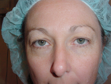Blepharoplasty Result Santa Monica