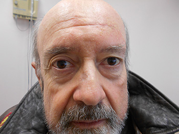 Brow Lift Results Santa Monica