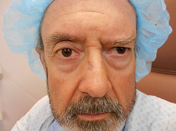 Brow Lift Santa Monica