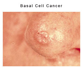 basal cell cancer